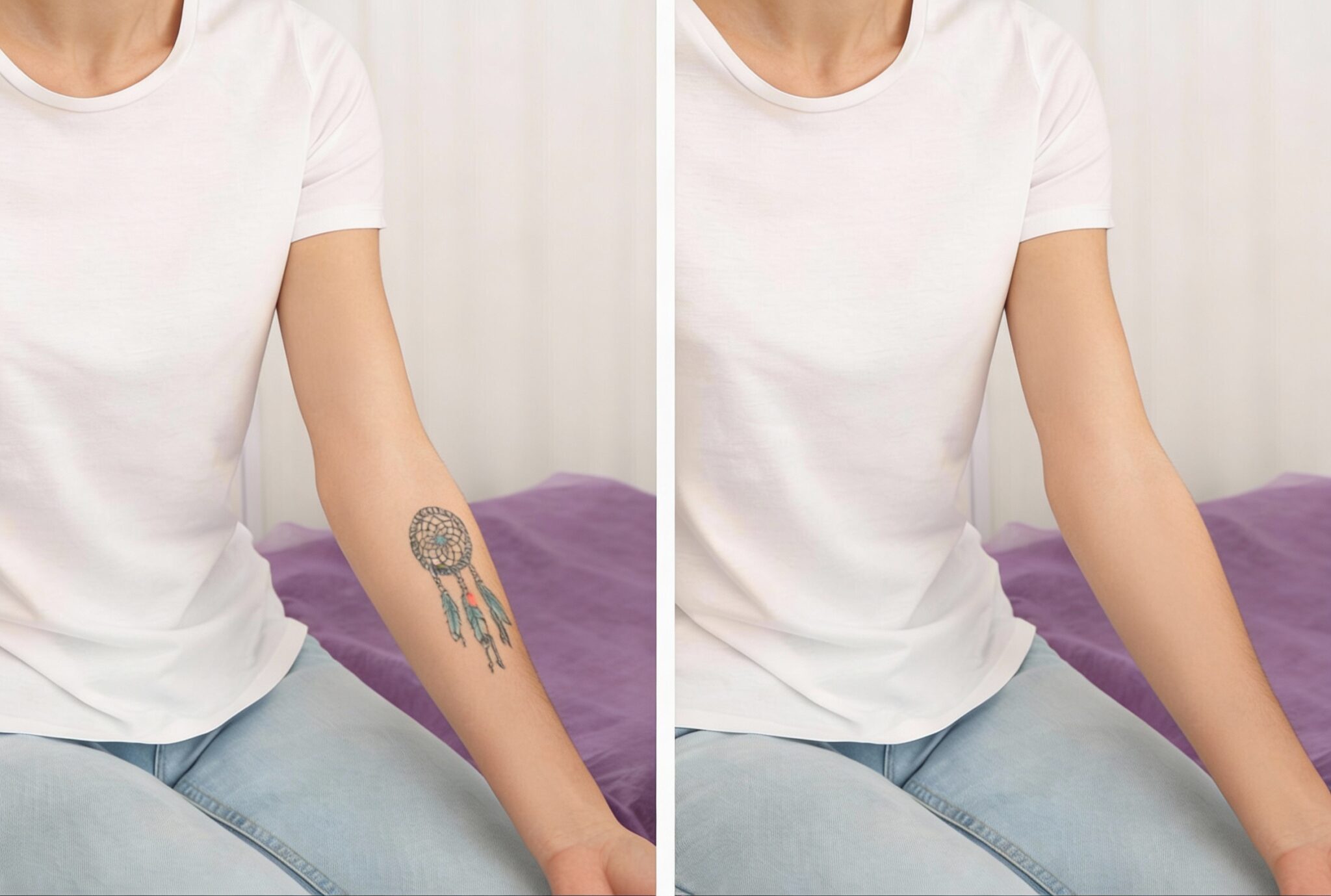 Before and after laser tattoo removal results