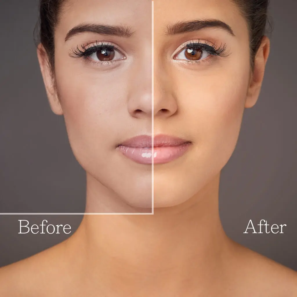 Results of Salmon DNA skin booster treatment