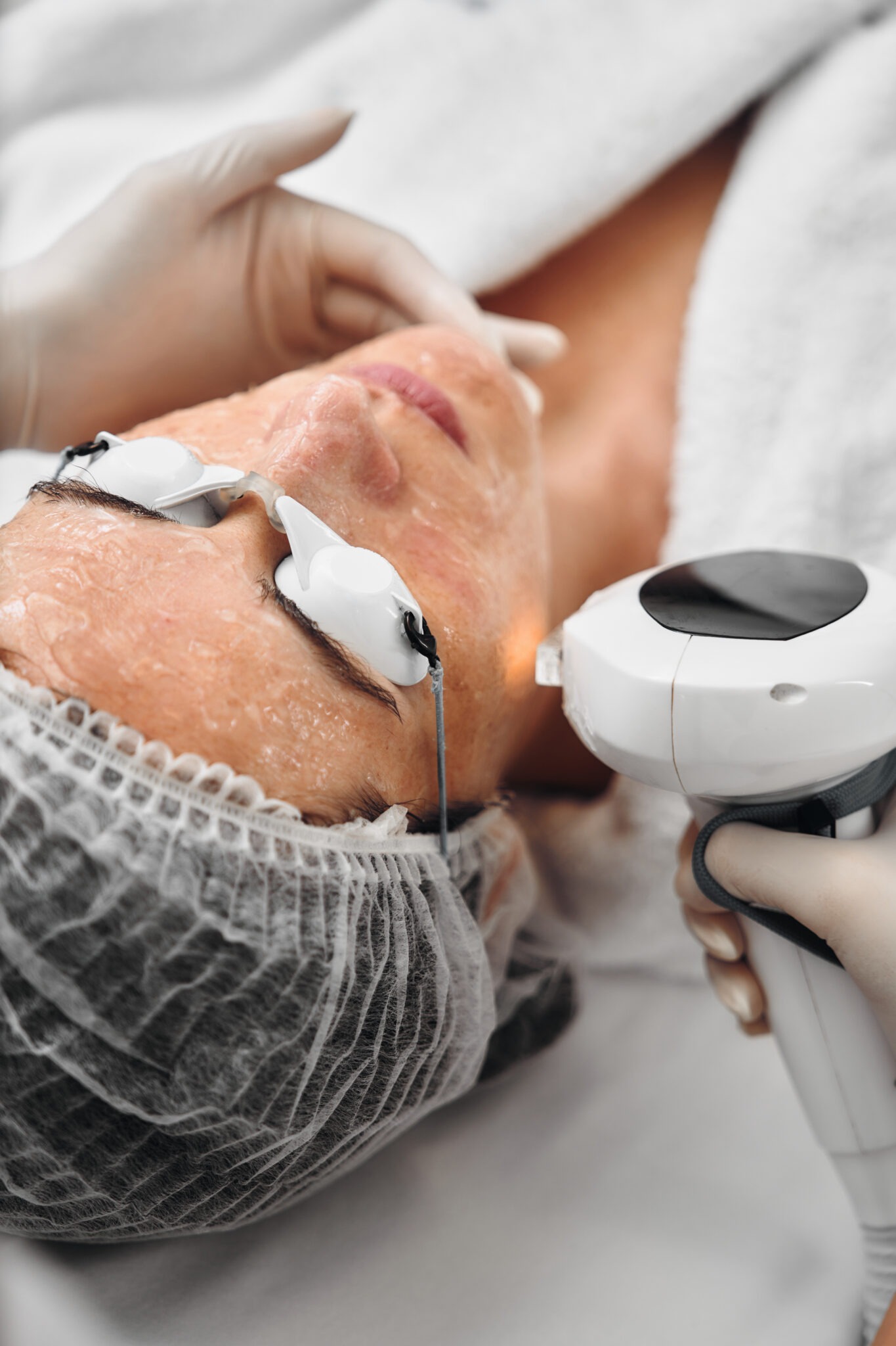 Fractional laser acne scar treatment with precision technology