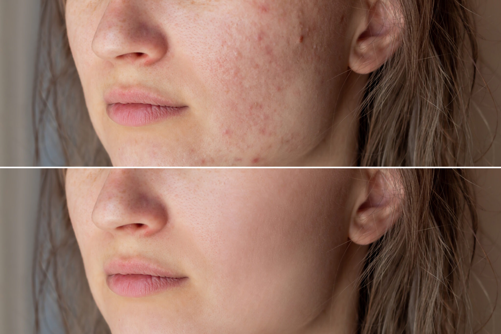 Before and after acne scar treatment results