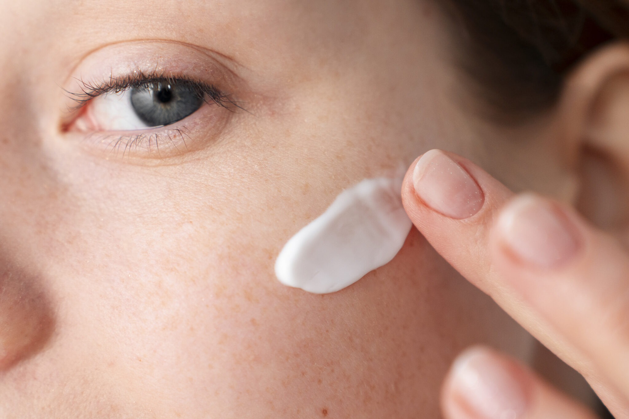 Sunscreen protection for melasma-prone skin