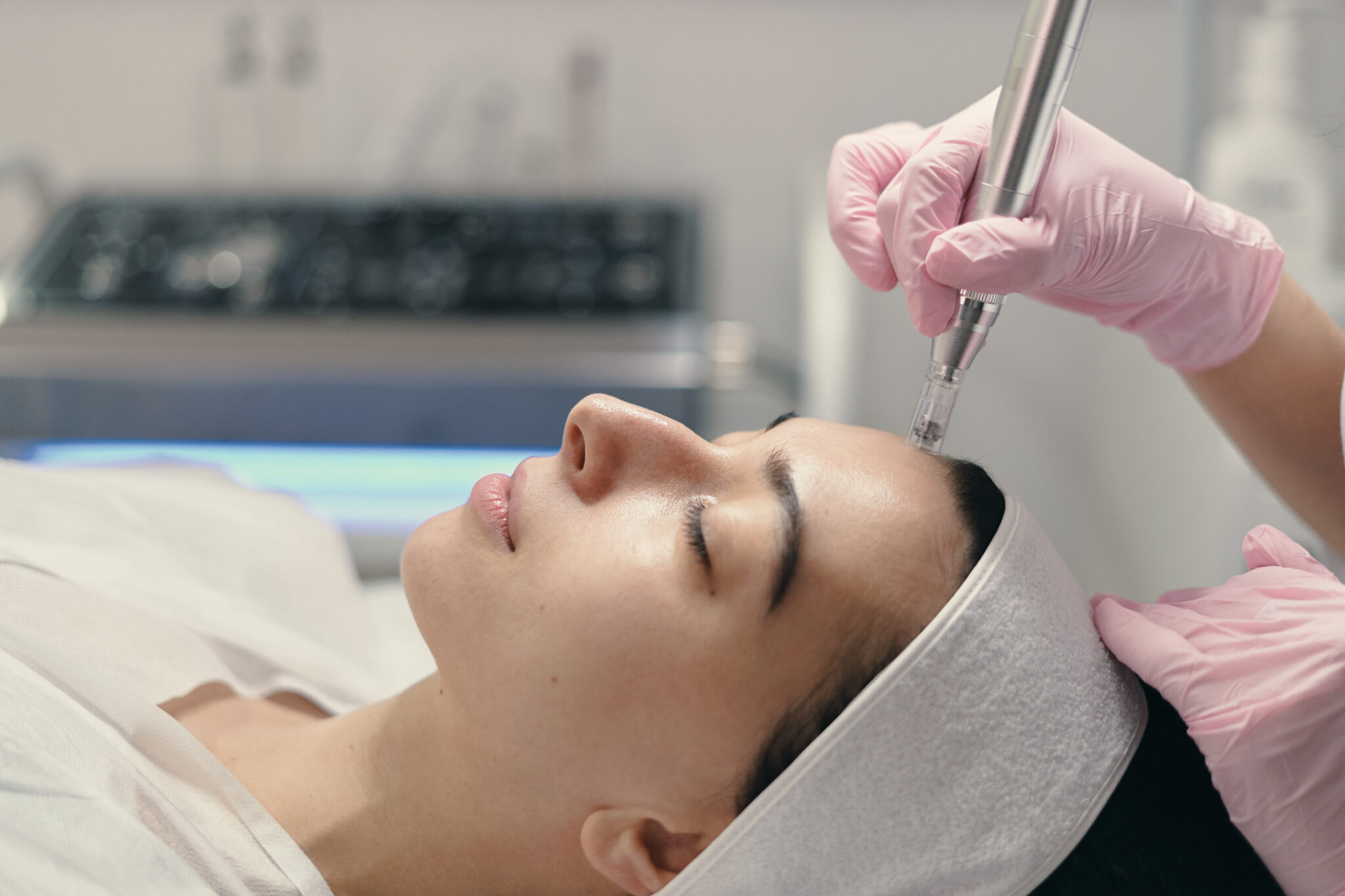 Microneedling for acne scars before Ramadan