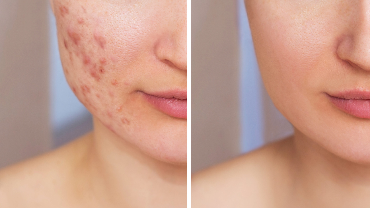 Before and after acne scar treatment showing improved skin texture and reduced scars