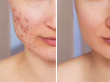 Before and after acne scar treatment showing improved skin texture and reduced scars