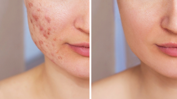 Before and after acne scar treatment showing improved skin texture and reduced scars