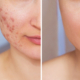 Before and after acne scar treatment showing improved skin texture and reduced scars