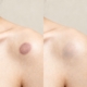 Before and after laser birthmark removal showing clearer skin